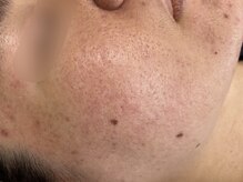 アロマ(AROMA)/凹凸ケア、開き毛穴　(4)