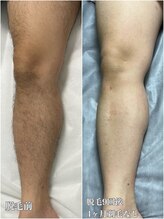 ルシャトン(Le Chaton)/あし脱毛