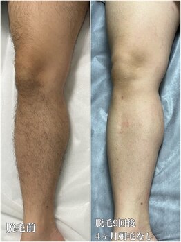 ルシャトン(Le Chaton)/あし脱毛