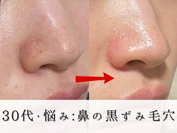 ジョンミー(JONMEE)/毛穴洗浄で黒ずみ毛穴改善!