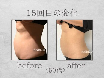 アンビーユー(ANBE.U)/腸もみビフォーアフター