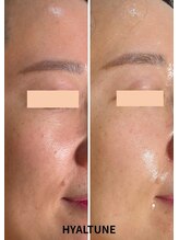 ルピナス ヒサヤ(LUPINUS hisaya)/韓国から上陸！水分ピール