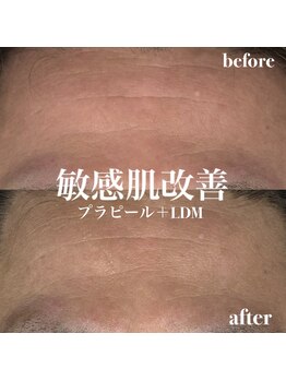 イロハ(IROHA)/敏感肌改善!