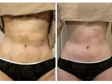 リム ビューティー(RYM BEAUTY)/インディバ ボディ術後