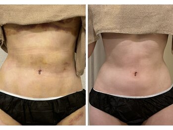 リム ビューティー(RYM BEAUTY)/インディバ ボディ術後