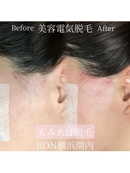 サロンロン 横浜関内(SALON RON)/もみあげ脱毛でスッキリ！