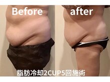 ユー 喜連西店(U)/脂肪冷却【before　after】