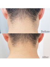 プリドー(PULIDO)/うなじ脱毛