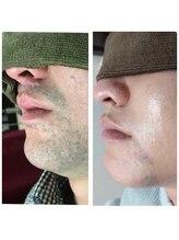 ルーミー(LUME.)/メンズヒゲ脱毛