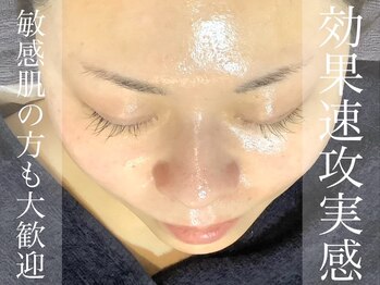 アンベール(unveil)/剥離無し ハーブピーリング