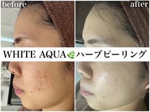 ホワイトアクア 広島店(WHITE AQUA)/ハーブピーリング/美白ケア