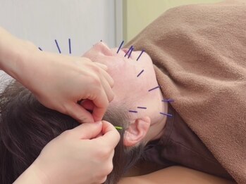 和燈/人気の美容鍼