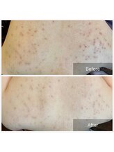 エミルカ 千葉店(EMILUCA)/ハーブピーリング/背中ニキビ