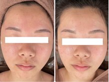 ホワイトアクア 岐阜店(WHITE AQUA)/ハーブピーリング/岐阜/ニキビ