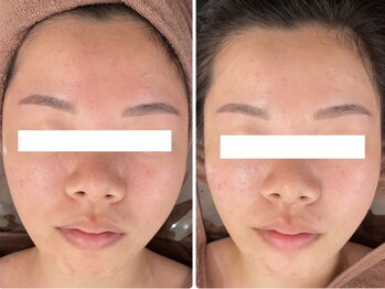 ホワイトアクア 岐阜店(WHITE AQUA)/ハーブピーリング/岐阜/ニキビ