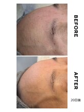 アロラヴィ(AroRavi)/肌質改善プログラム