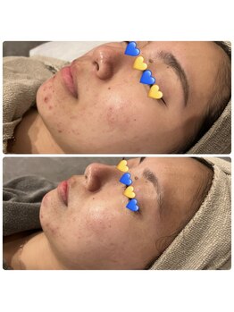 ブルー(blue.)/剥離ありハードハーブピーリング