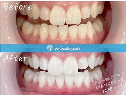 歯のホワイトニングWhiteningCafe六本木店【ホワイトニングカフェ】の写真