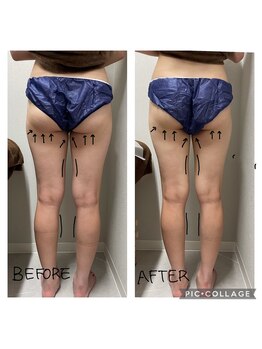 エンチャント(ENCHANT)/一回効果抜群！お尻太ももケア