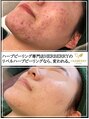 キャンディ 岐阜(CANDi)&nbsp;ピーリング 毛穴相性◎