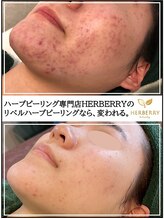 キャンディ 岐阜(CANDi)&nbsp;ピーリング 毛穴相性◎