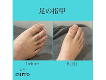 アクト クロ(ACT curro)/【足の指甲】脱毛施術例