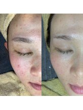 ミーミー 多治見店(MeMe.)/ 毛穴エクストラクション