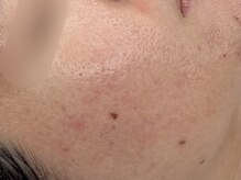 アロマ(AROMA)/凹凸ケア、開き毛穴　(4)