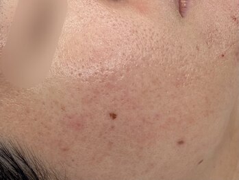 アロマ(AROMA)/凹凸ケア、開き毛穴　(4)