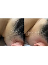 ヒロット タオ(HILOT TAO)/Sugaring うなじ脱毛