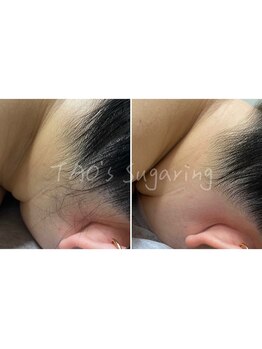 ヒロット タオ(HILOT TAO)/Sugaring うなじ脱毛