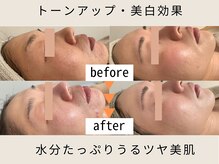 2ヶ月集中コース＋ホームケアで最短で明るくきめ細かい肌に。