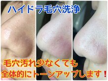 ハナン(Hanan)/ハイドラ毛穴洗浄