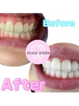 エクシアホワイトニング 大府店/ホワイトニングビフォーアフター