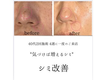 シミリセット 名駅(シミReset)/どの部位のシミも、施術可能