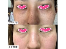 ミニョン(Mignon)/植村のシミ変化写真