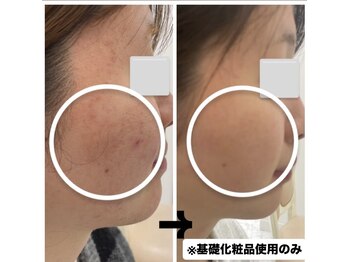 エステサロンパリス(Esthe Salon Paris)/19歳の繰り返すニキビ肌も改善！