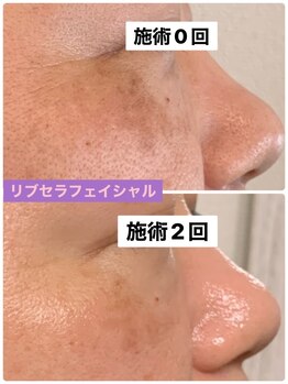 プリュネル(Prunelle)/プラズマシャワー