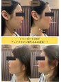 ティー(T)&nbsp;レモンボトル！1回でお肌リフトアップ☆