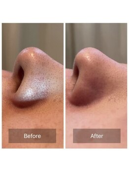 ティーズキッス(T’s Kiss)/毛穴の黒ずみが気になる方へ