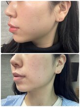 ルアナライフ(Luana Life)/ニキビ肌改善にも《REDSHOT》