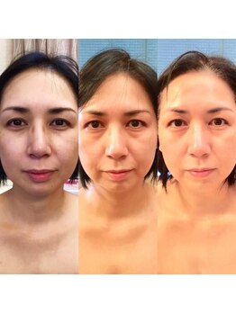 アクアリュース(Aquqrius)の写真/高濃度３種のヒト幹細胞培養液を、高圧エアジェットでお肌に届ける♪