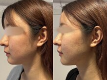 ピュアリー(purly)/【レモンボトル】Before After