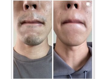 リラ 都城店(Lilas)の写真/毎朝のヒゲ剃りが楽に♪青ヒゲやカミソリ負けにお悩みの方必見！美肌効果も◎【ヒゲ脱毛(1回)初回¥2500】