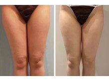 ルナグランデ(Luna grande.)/膝上無くすとスッキリしますよ！