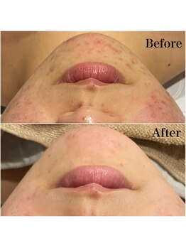 リブ(Lib)/HAAB REPRO☆