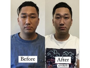 コルミチョン サロン(骨美整 salon)/Before・After &nbsp;6回施術