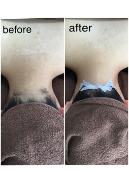 ポノ(pono)/最新LED脱毛