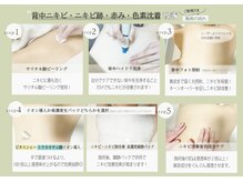 ビズビズ 天王寺店(bisebise)/背中ニキビニキビ.跡/毛孔性苔癬