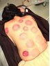 鍼灸施術+カッピング(施術時間60分)7,500円